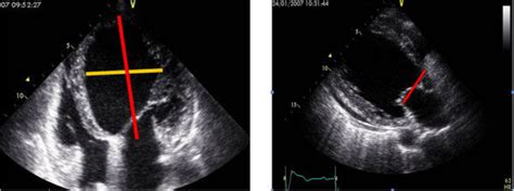 sphericity index echo.